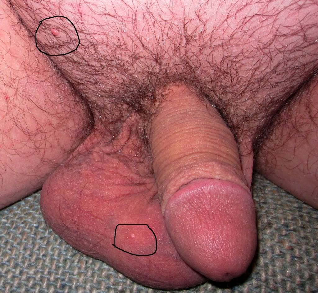 Inflamed Hair Follicle Penis 113