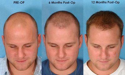 hair photo:american hair loss association 