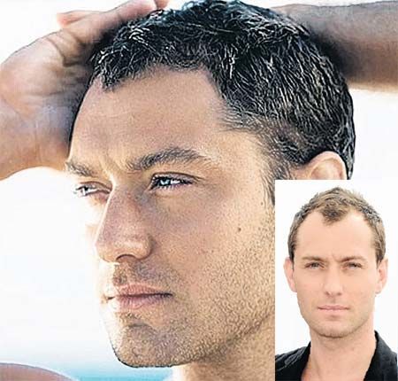 hair photo:beta sitosterol hair loss 