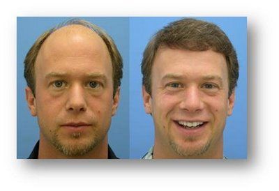 hair photo:nettle root hair loss 